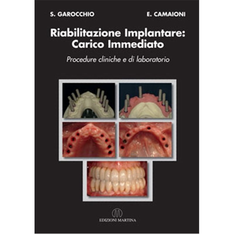 RIABILITAZIONE IMPLANTARE: CARICO IMMEDIATO - Procedure cliniche e di laboratorio